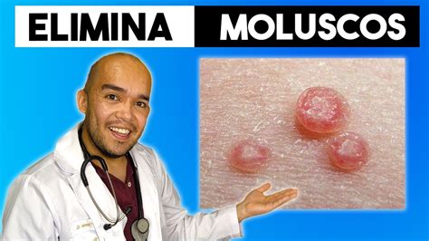 como eliminar molusco contagioso naturalmente|Cómo Curar El Molusco Contagioso Con。